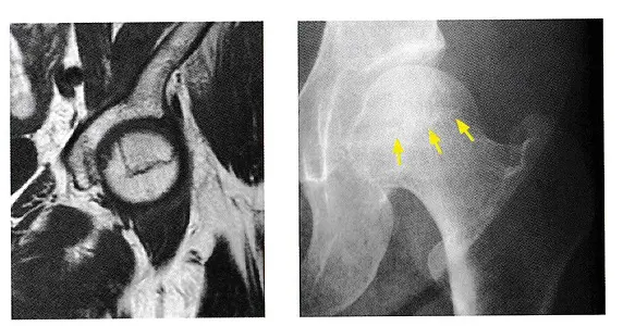 特発性大腿骨頭壊死症について① | 石坂整形外科